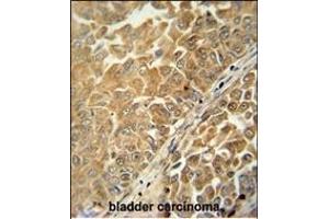 C antibody (Center) (ABIN654959 and ABIN2844598) immunohistochemistry analysis in formalin fixed and paraffin embedded human bladder carcinoma followed by peroxidase conjugation of the secondary antibody and DAB staining. (C18ORF25 antibody  (AA 163-191))