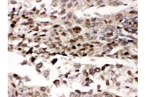 Anti- AMPK beta 2 Picoband antibody, IHC(P) IHC(P): Human Lung Cancer Tissue (PRKAB2 antibody  (N-Term))