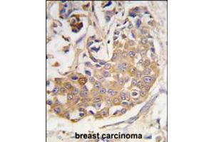 Formalin-fixed and paraffin-embedded human breast carcinoma tissue reacted with COL9A1 antibody , which was peroxidase-conjugated to the secondary antibody, followed by DAB staining.