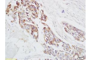 Formalin-fixed and paraffin embedded human rectal carcinoma labeled with Anti-Ensconsin Polyclonal Antibody, Unconjugated  at 1:200 followed by conjugation to the secondary antibody and DAB staining (MAP7 antibody  (AA 151-250))