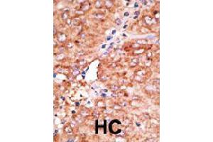 Formalin-fixed and paraffin-embedded human hepatocellular carcinoma tissue reacted with CCBP2 polyclonal antibody  , which was peroxidase-conjugated to the secondary antibody, followed by AEC staining. (CCBP2 antibody  (C-Term))