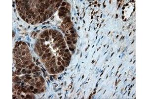 Immunohistochemical staining of paraffin-embedded Adenocarcinoma of colon tissue using anti-LTA4H mouse monoclonal antibody. (LTA4H antibody)