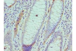 Immunohistochemistry of paraffin-embedded human colon cancer using ABIN7143460 at dilution of 1: 100 (ARFGAP1 antibody  (AA 1-220))