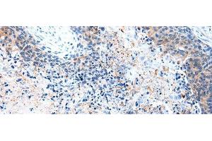 Immunohistochemistry of paraffin-embedded Human esophagus cancer tissue using COLEC12 Polyclonal Antibody at dilution 1:40 (COLEC12 antibody)