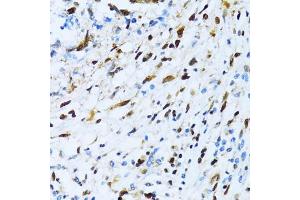 Immunohistochemistry of paraffin-embedded human gastric cancer using XRCC4 antibody (ABIN3022381, ABIN3022382, ABIN3022383 and ABIN6218772) at dilution of 1:100 (40x lens). (XRCC4 antibody  (AA 1-336))