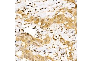 Immunohistochemistry of paraffin-embedded human breast cancer using GPS1 Rabbit pAb (ABIN6127934, ABIN6141361, ABIN6141362 and ABIN6222653) at dilution of 1:250 (40x lens). (GPS1 antibody  (AA 258-527))