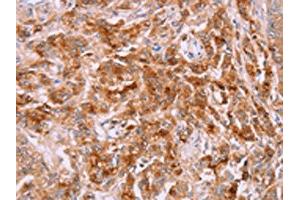 The image on the left is immunohistochemistry of paraffin-embedded Human prostate cancer tissue using ABIN7191308(LPCAT4 Antibody) at dilution 1/15, on the right is treated with synthetic peptide. (LPCAT4 antibody)