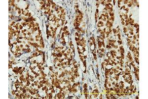 Immunoperoxidase of monoclonal antibody to KIAA0056 on formalin-fixed paraffin-embedded human breast cancer tissue. (NCAPD3 antibody  (AA 1-341))