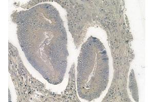 ABIN6256226 and ABIN6267081 at 1/100 staining human colon carcinoma by IHC-P.