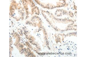 Immunohistochemistry of Human colon cancer using ABL2 Polyclonal Antibody at dilution of 1:25 (ABL2 antibody)