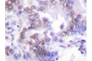 Immunohistochemical analysis of paraffin-embedded human lung carcinoma tissue using SENP6 polyclonal antibody . (SENP6 antibody)