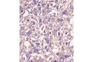 (ABIN652875 and ABIN2842566) staining HP in human epatocarcinoma sections by Immunohistochemistry (IHC-P - paraformaldehyde-fixed, paraffin-embedded sections). (Haptoglobin antibody  (Center))