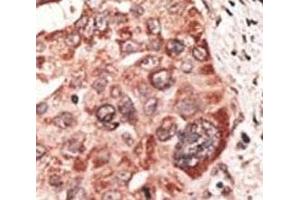 IHC analysis of FFPE human hepatocarcinoma tissue stained with the Recoverin antibody (Recoverin antibody  (AA 169-200))