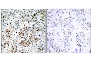 Immunohistochemical analysis of paraffin-embedded human breast carcinoma tissue using CREB (Ab-133) antibody (E021052). (CREB1 antibody)