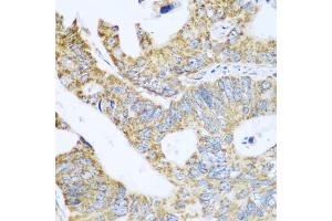 Immunohistochemistry of paraffin-embedded human colon carcinoma using GLUD1 antibody (ABIN5975614) at dilution of 1/100 (40x lens). (GLUD1 antibody)