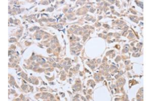 The image on the left is immunohistochemistry of paraffin-embedded Human breast cancer tissue using ABIN7128138(ABHD5 Antibody) at dilution 1/10, on the right is treated with fusion protein. (ABHD5 antibody)