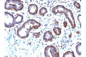Formalin-fixed, paraffin-embedded human Breast Carcinoma stained with Ferritin LC Rabbit Recombinant Monoclonal Antibody (FTL/2338R). (Recombinant FTL antibody  (AA 38-165))
