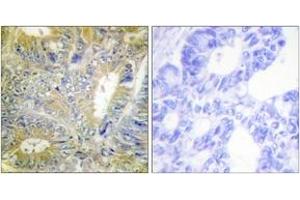 Immunohistochemistry analysis of paraffin-embedded human colon carcinoma tissue, using Desmin (Ab-60) Antibody. (Desmin antibody  (AA 26-75))