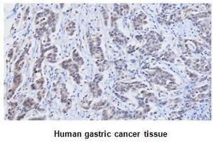 Paraffin embedded sections of human gastric canitrocelluloseer tissue were initrocelluloseubated with anti-human RBP4 (1:25) for 2 hours at room temperature. (RBP4 antibody  (AA 19-201))