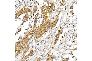 Immunohistochemistry of paraffin-embedded human breast cancer using UQCRH Rabbit mAb (ABIN7271126) at dilution of 1:50 (40x lens). (UQCRH antibody)