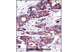 N Antibody (C-term) ((ABIN389343 and ABIN2839452))immunohistochemistry analysis in formalin fixed and paraffin embedded human colon carcinoma followed by peroxidase conjugation of the secondary antibody and DAB staining. (NPM1 antibody  (C-Term))