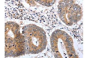 The image on the left is immunohistochemistry of paraffin-embedded Human colon cancer tissue using ABIN7192042(PSPN Antibody) at dilution 1/25, on the right is treated with synthetic peptide.