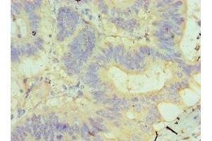 Immunohistochemistry of paraffin-embedded human colon cancer using ABIN7145506 at dilution of 1:100 (Glucuronidase beta antibody  (AA 382-651))