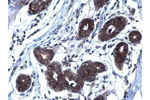 IHC-P Image RANKL antibody [C2C3], C-term detects RANKL protein at membrane on human breast carcinoma by immunohistochemical analysis. (RANKL antibody  (C-Term))