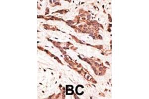 Formalin-fixed and paraffin-embedded human cancer tissue reacted with the primary antibody, which was peroxidase-conjugated to the secondary antibody, followed by AEC staining. (EDG4 antibody  (N-Term))