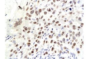 Formalin-fixed and paraffin embedded human laryngeal squamous cell carcinoma labeled Anti-P21/CDKN1A Polyclonal Antibody, Unconjugated (ABIN672606) at 1:200, followed by conjugation to the secondary antibody and DAB staining