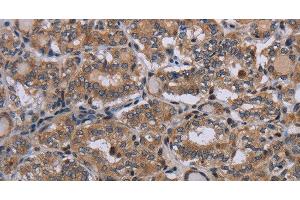 Immunohistochemistry of paraffin-embedded Human thyroid cancer using P2RX2 Polyclonal Antibody at dilution of 1:50