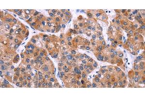 Immunohistochemistry of paraffin-embedded Human liver cancer tissue using MSMO1 Polyclonal Antibody at dilution 1:40 (SC4MOL antibody)