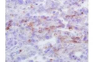 Formalin-fixed and paraffin embedded human lung carcinoma labeled with Rabbit Anti-CXCL1 Polyclonal Antibody, Unconjugated (ABIN2173443) at 1:200 followed by conjugation to the secondary antibody and DAB staining (CXCL1 antibody  (AA 51-107))