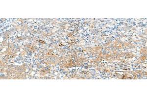 Immunohistochemistry of paraffin-embedded Human cervical cancer tissue using HLA-DRB3 Polyclonal Antibody at dilution of 1:50(x200) (HLA-DRB3 antibody)