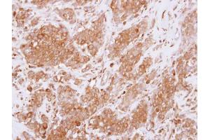 IHC-P Image Immunohistochemical analysis of paraffin-embedded human breast cancer, using RGS10, antibody at 1:250 dilution. (RGS10 antibody)