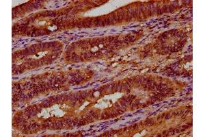 IHC image of ABIN7174645 diluted at 1:300 and staining in paraffin-embedded human colon cancer performed on a Leica BondTM system. (UGT2B7 antibody  (AA 237-382))