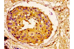 IHC image of ABIN7143742 diluted at 1:100 and staining in paraffin-embedded human breast cancer performed on a Leica BondTM system. (ORM1 antibody  (AA 19-201))
