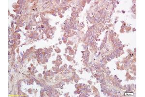 Formalin-fixed and paraffin embedded human lung carcinoma labeled with Rabbit Anti GCS/glucosylceramide synthase Polyclonal Antibody, Unconjugated (ABIN672096) at 1:200 followed by conjugation to the secondary antibody and DAB staining