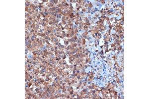 Immunohistochemistry of paraffin-embedded human thyroid cancer using PKC delta Rabbit mAb  at dilution of 1:100 (40x lens). (PKC delta antibody)