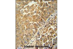 CR025 antibody immunohistochemistry analysis in formalin fixed and paraffin embedded human bladder carcinoma followed by peroxidase conjugation of the secondary antibody and DAB staining. (C18ORF25 antibody  (AA 163-191))