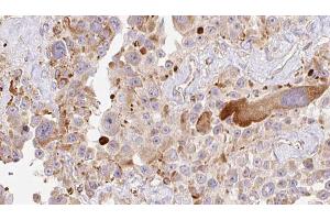 ABIN6274010 at 1/100 staining Human Melanoma tissue by IHC-P. (HAPLN1 antibody  (N-Term))