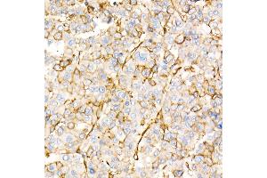 Immunohistochemistry of paraffin-embedded human liver cancer using Annexin  Rabbit pAb  at dilution of 1:25 (40x lens).