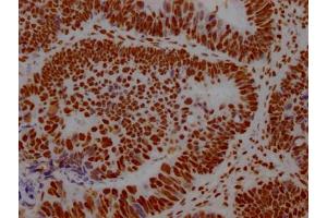 IHC image of ABIN7127571 diluted at 1:100 and staining in paraffin-embedded human ovarian cancer performed on a Leica BondTM system. (Recombinant Interleukin enhancer-binding factor 3 (ILF3) antibody)