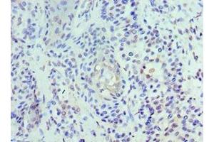 Immunohistochemistry of paraffin-embedded human breast cancer using ABIN7174459 at dilution of 1:100