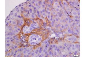 Formalin-fixed and paraffin embedded human laryngocarcinoma labeled with Anti-CK7 Polyclonal Antibody, Unconjugated  at 1:300 followed by conjugation to the secondary antibody and DAB staining. (Cytokeratin 7 antibody  (AA 251-350))