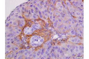 Formalin-fixed and paraffin embedded human laryngocarcinoma labeled with Anti-CK7 Polyclonal Antibody, Unconjugated  at 1:300 followed by conjugation to the secondary antibody and DAB staining. (Cytokeratin 7 antibody  (AA 251-350))