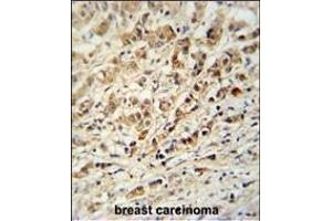 AVL9 Antibody (C-term) (ABIN651037 and ABIN2840044) immunohistochemistry analysis in formalin fixed and paraffin embedded human breast carcinoma followed by peroxidase conjugation of the secondary antibody and DAB staining. (AVL9 antibody  (C-Term))