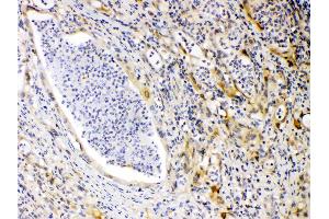 PRKAR1A was detected in paraffin-embedded sections of human intestinal cancer tissues using rabbit anti- PRKAR1A Antigen Affinity purified polyclonal antibody (Catalog # ) at 1 µg/mL. (PRKAR1A antibody  (AA 2-81))