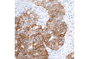 Immunohistochemistry (IHC) image for anti-Epithelial Cell Adhesion Molecule (EPCAM) (AA 264-314) antibody (ABIN7455204) (Recombinant EpCAM antibody  (AA 264-314))