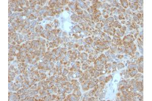 Formalin-fixed, paraffin-embedded human Melanoma stained with Bcl-2 Monoclonal Antibody (BCL2/782 + BCL2/796). (Bcl-2 antibody)
